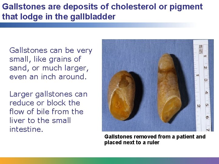 Gallstones are deposits of cholesterol or pigment that lodge in the gallbladder Gallstones can