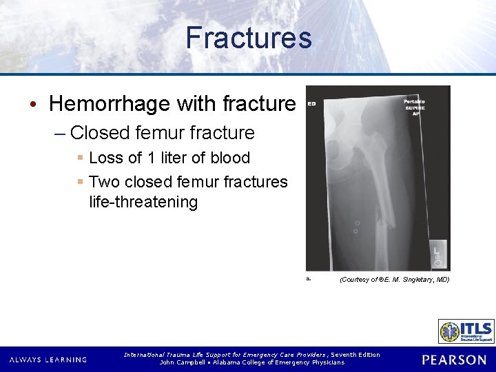 Fractures • Hemorrhage with fracture – Closed femur fracture § Loss of 1 liter