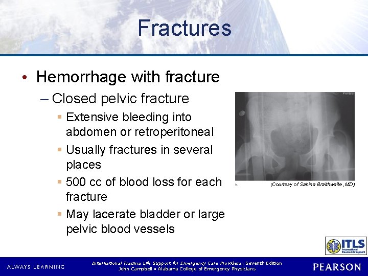 Fractures • Hemorrhage with fracture – Closed pelvic fracture § Extensive bleeding into abdomen