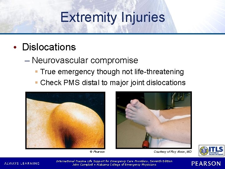 Extremity Injuries • Dislocations – Neurovascular compromise § True emergency though not life-threatening §