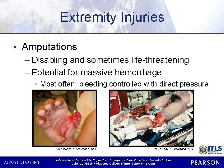 Extremity Injuries • Amputations – Disabling and sometimes life-threatening – Potential for massive hemorrhage