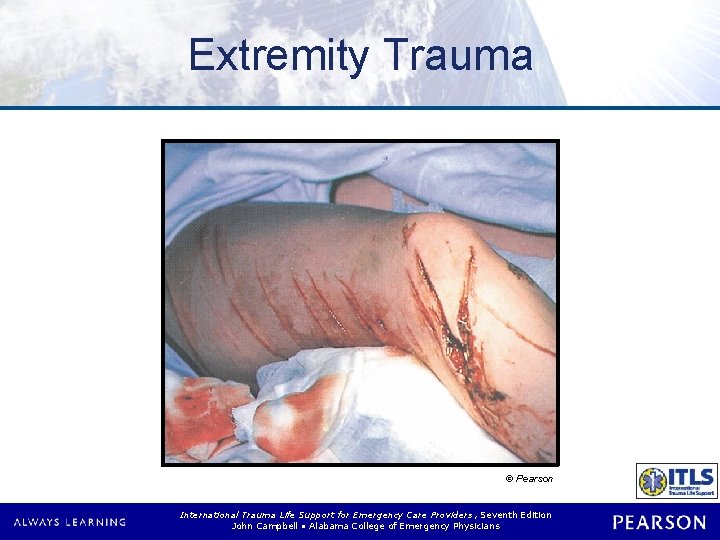 Extremity Trauma © Pearson International Trauma Life Support for Emergency Care Providers, Seventh Edition