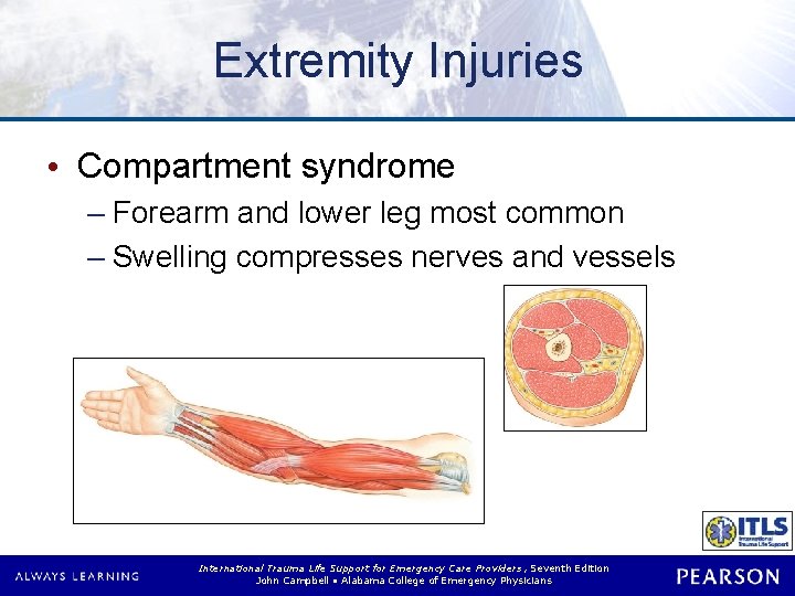 Extremity Injuries • Compartment syndrome – Forearm and lower leg most common – Swelling