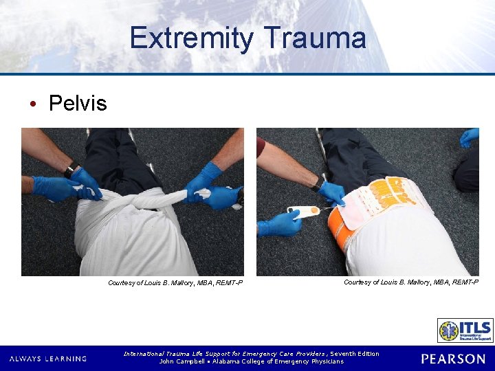 Extremity Trauma • Pelvis Courtesy of Louis B. Mallory, MBA, REMT-P International Trauma Life