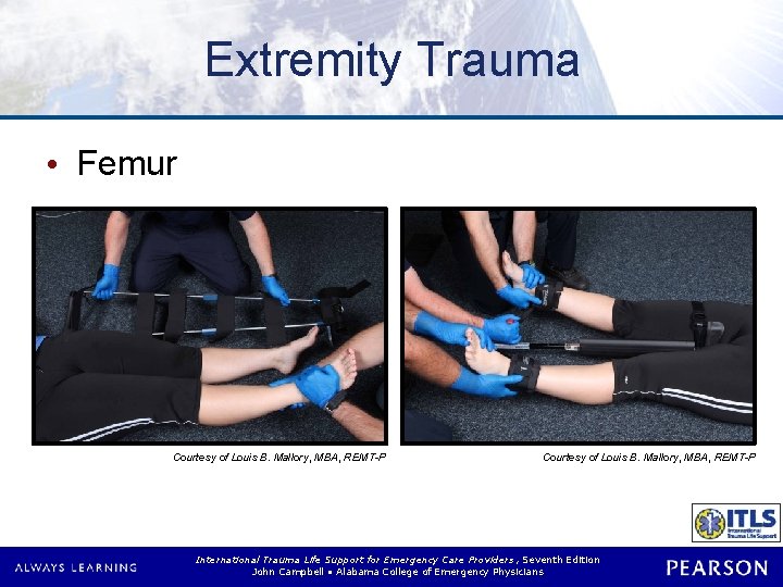 Extremity Trauma • Femur Courtesy of Louis B. Mallory, MBA, REMT-P International Trauma Life
