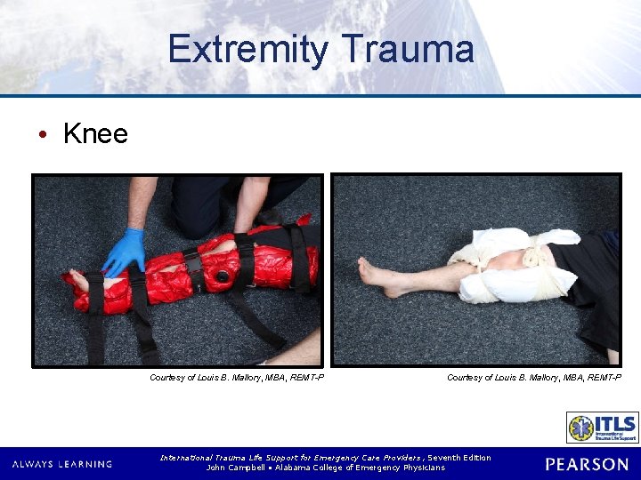 Extremity Trauma • Knee Courtesy of Louis B. Mallory, MBA, REMT-P International Trauma Life