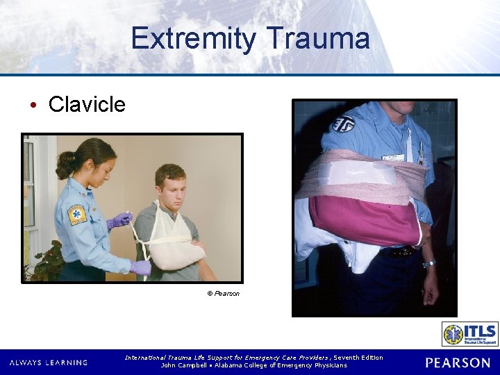 Extremity Trauma • Clavicle © Pearson International Trauma Life Support for Emergency Care Providers,