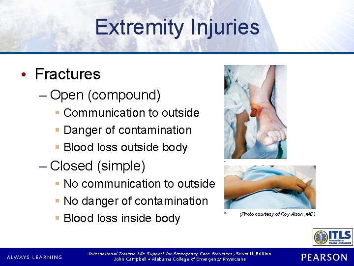 Extremity Injuries • Fractures – Open (compound) § Communication to outside § Danger of