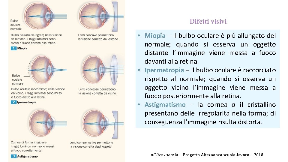 Difetti visivi • Miopia – il bulbo oculare è più allungato del normale; quando