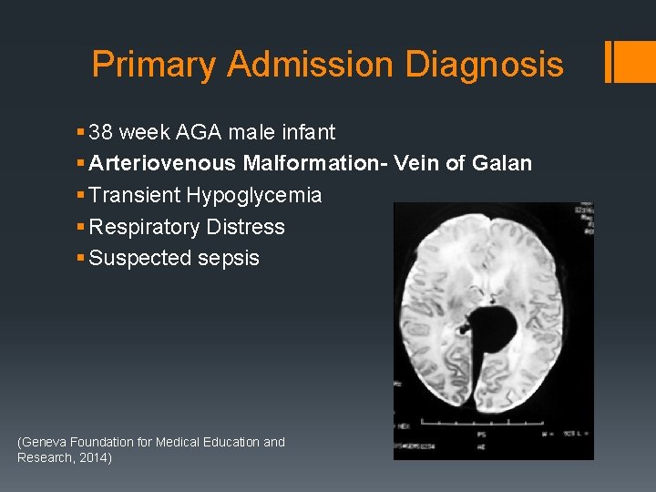 Primary Admission Diagnosis § 38 week AGA male infant § Arteriovenous Malformation- Vein of