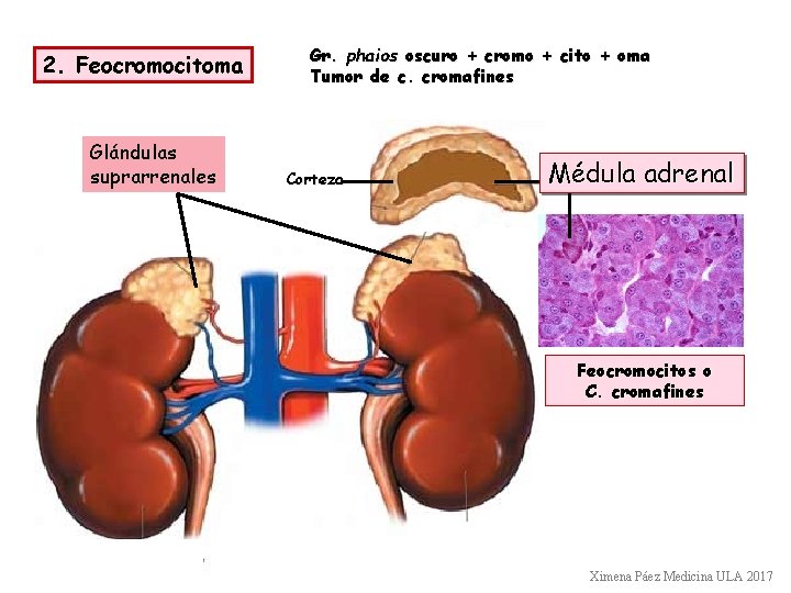 2. Feocromocitoma Glándulas suprarrenales Gr. phaios oscuro + cromo + cito + oma Tumor