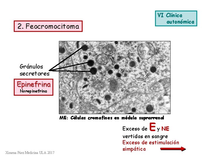 VI Clínica autonómica 2. Feocromocitoma Gránulos secretores Epinefrina Norepinefrina ME: Células cromafines en médula