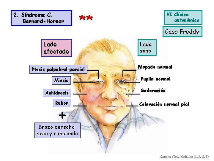 2. Síndrome C. Bernard-Horner ** Lado afectado Ptosis palpebral parcial Miosis Anhidrosis Rubor +