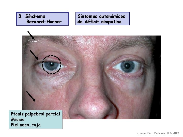 3. Síndrome Bernard-Horner Síntomas autonómicos de déficit simpático Ptosis palpebral parcial Miosis Piel seca,