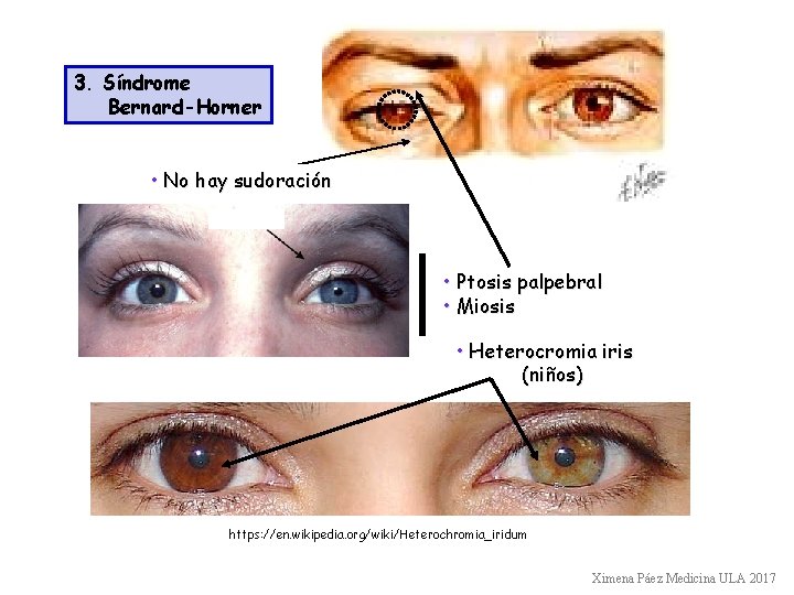 3. Síndrome Bernard-Horner • No hay sudoración • Ptosis palpebral • Miosis • Heterocromia