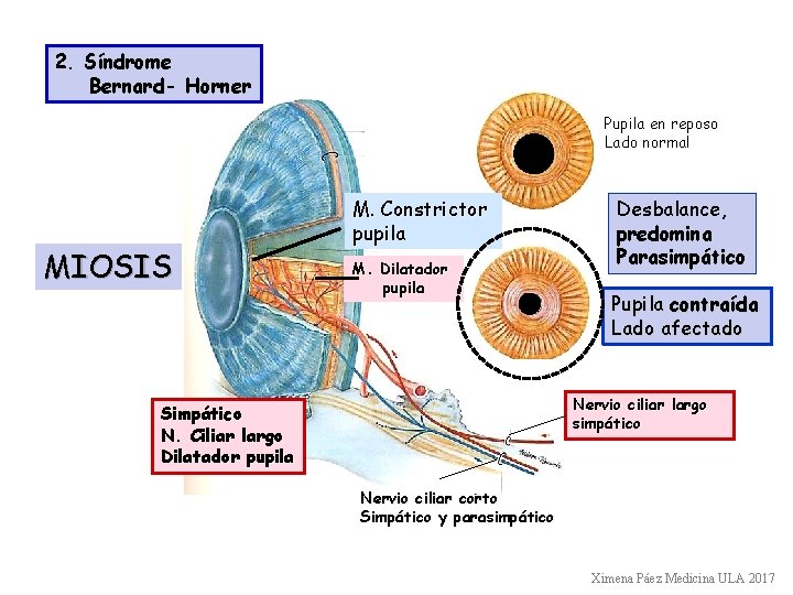 2. Síndrome Bernard- Horner Pupila en reposo Lado normal MIOSIS M. Constrictor pupila M.