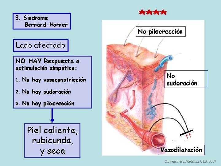 **** 3. Síndrome Bernard-Horner Lado afectado 4. No piloerección 3. NO HAY Respuesta a