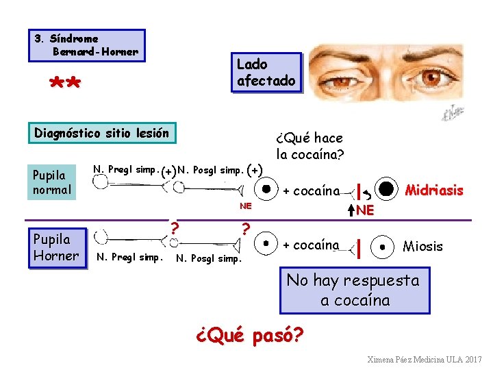 3. Síndrome Bernard-Horner Lado afectado ** Diagnóstico sitio lesión Pupila normal N. Pregl simp.