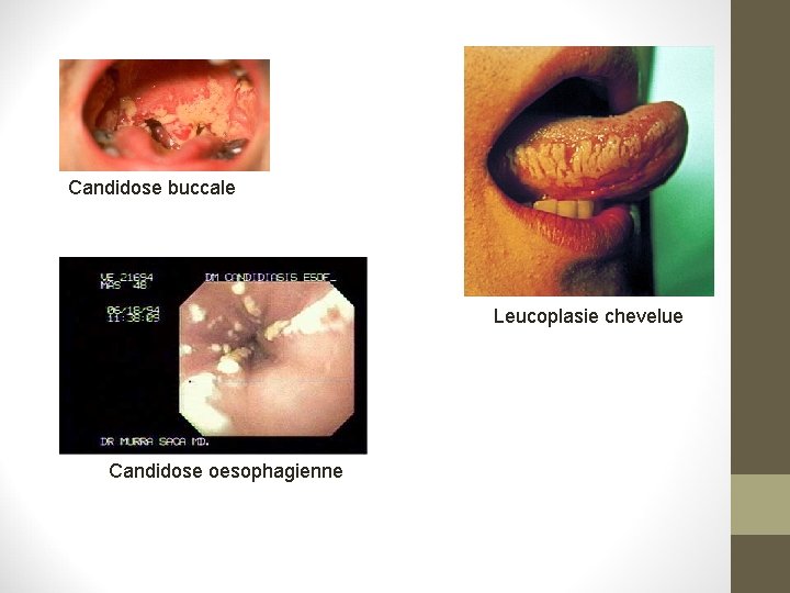 Candidose buccale Leucoplasie chevelue Candidose oesophagienne Candidose buccale Leucoplasie chevelue Candidose oesophagienne