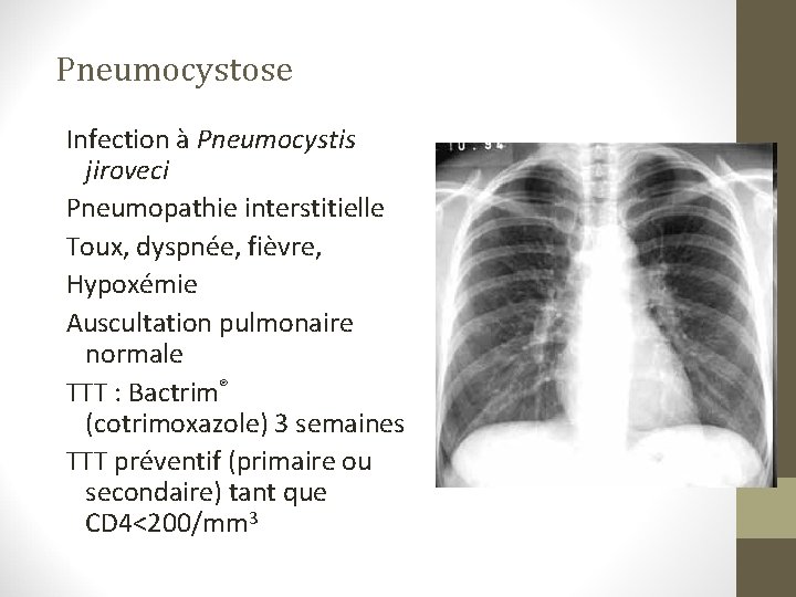 Pneumocystose Infection à Pneumocystis jiroveci Pneumopathie interstitielle Toux, dyspnée, fièvre, Hypoxémie Auscultation pulmonaire normale Pneumocystose Infection à Pneumocystis jiroveci Pneumopathie interstitielle Toux, dyspnée, fièvre, Hypoxémie Auscultation pulmonaire normale