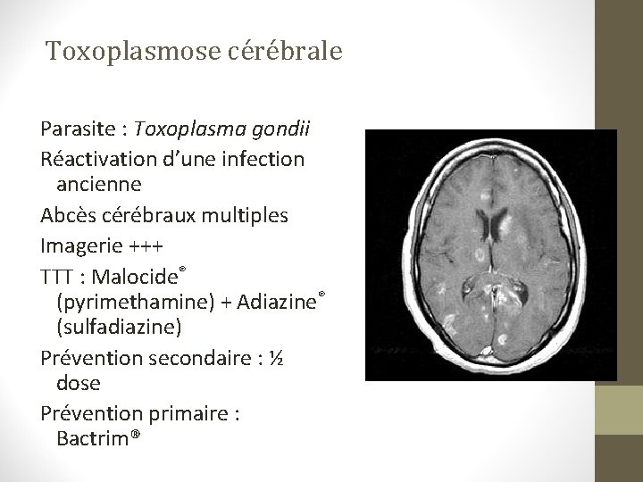 Toxoplasmose cérébrale Parasite : Toxoplasma gondii Réactivation d’une infection ancienne Abcès cérébraux multiples Imagerie Toxoplasmose cérébrale Parasite : Toxoplasma gondii Réactivation d’une infection ancienne Abcès cérébraux multiples Imagerie
