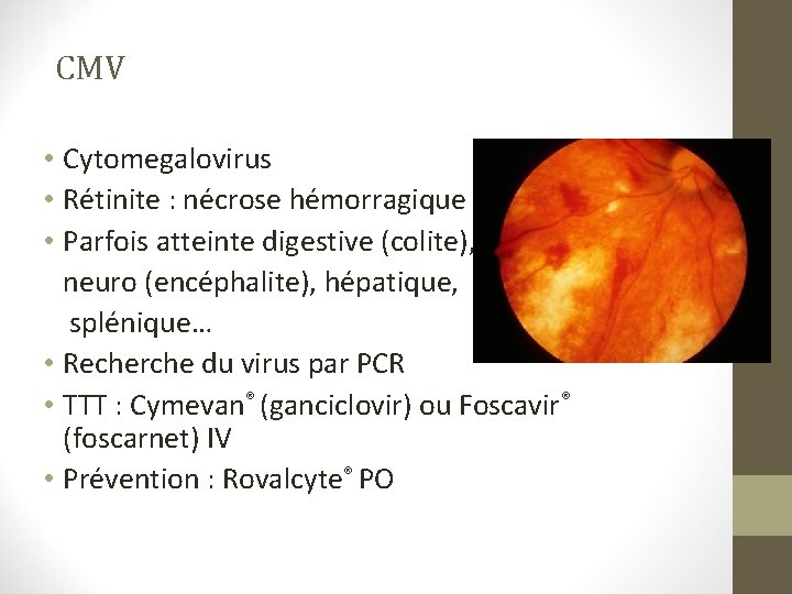 CMV • Cytomegalovirus • Rétinite : nécrose hémorragique • Parfois atteinte digestive (colite), neuro CMV • Cytomegalovirus • Rétinite : nécrose hémorragique • Parfois atteinte digestive (colite), neuro