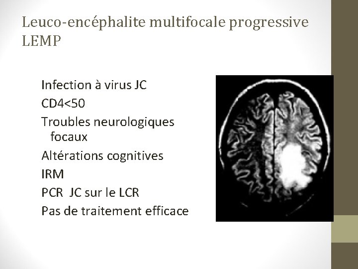 Leuco-encéphalite multifocale progressive LEMP Infection à virus JC CD 4<50 Troubles neurologiques focaux Altérations Leuco-encéphalite multifocale progressive LEMP Infection à virus JC CD 4<50 Troubles neurologiques focaux Altérations