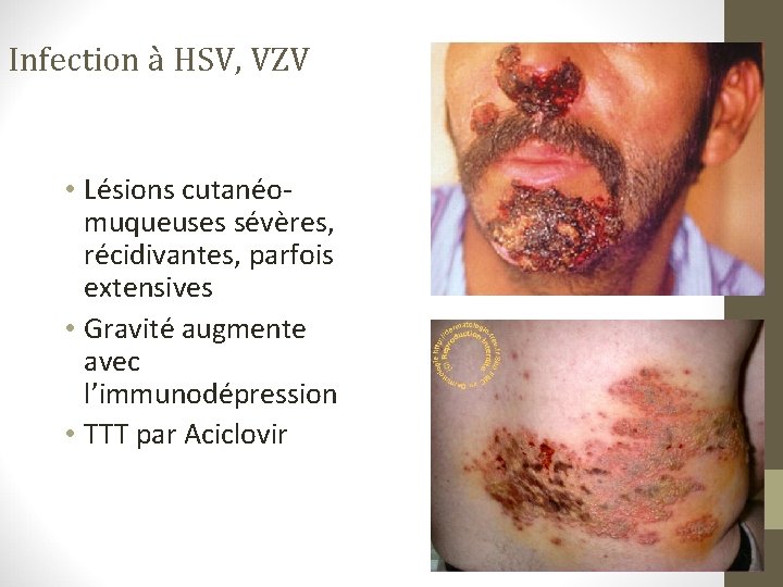 Infection à HSV, VZV • Lésions cutanéomuqueuses sévères, récidivantes, parfois extensives • Gravité augmente Infection à HSV, VZV • Lésions cutanéomuqueuses sévères, récidivantes, parfois extensives • Gravité augmente