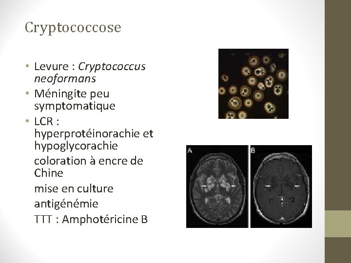 Cryptococcose • Levure : Cryptococcus neoformans • Méningite peu symptomatique • LCR : hyperprotéinorachie Cryptococcose • Levure : Cryptococcus neoformans • Méningite peu symptomatique • LCR : hyperprotéinorachie