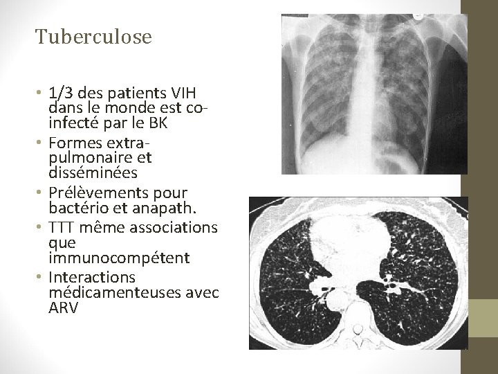 Tuberculose • 1/3 des patients VIH dans le monde est coinfecté par le BK Tuberculose • 1/3 des patients VIH dans le monde est coinfecté par le BK