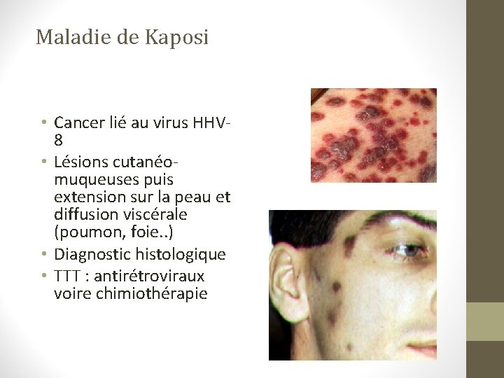 Maladie de Kaposi • Cancer lié au virus HHV 8 • Lésions cutanéomuqueuses puis Maladie de Kaposi • Cancer lié au virus HHV 8 • Lésions cutanéomuqueuses puis