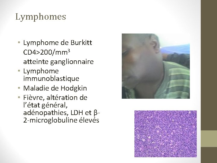 Lymphomes • Lymphome de Burkitt CD 4>200/mm 3 atteinte ganglionnaire • Lymphome immunoblastique • Lymphomes • Lymphome de Burkitt CD 4>200/mm 3 atteinte ganglionnaire • Lymphome immunoblastique •