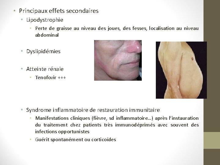 • Principaux effets secondaires • Lipodystrophie • Perte de graisse au niveau des • Principaux effets secondaires • Lipodystrophie • Perte de graisse au niveau des