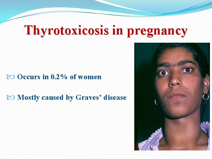 Thyrotoxicosis in pregnancy Occurs in 0. 2% of women Mostly caused by Graves’ disease