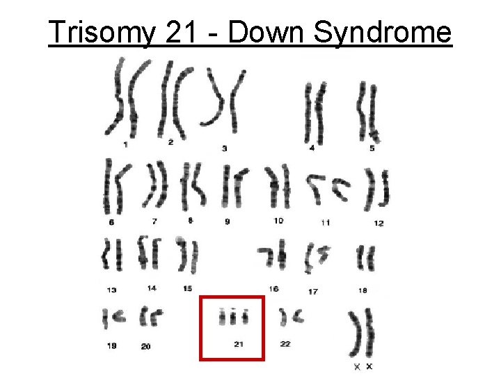 Trisomy 21 - Down Syndrome 