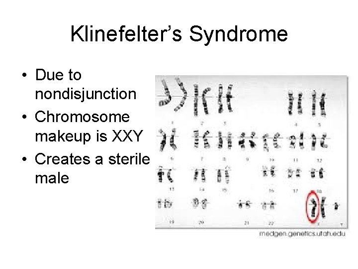 Klinefelter’s Syndrome • Due to nondisjunction • Chromosome makeup is XXY • Creates a