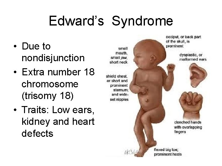 Edward’s Syndrome • Due to nondisjunction • Extra number 18 chromosome (trisomy 18) •