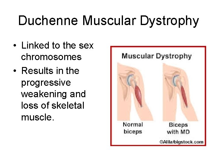 Duchenne Muscular Dystrophy • Linked to the sex chromosomes • Results in the progressive