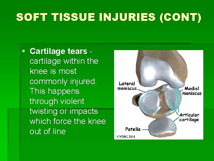 SOFT TISSUE INJURIES (CONT) § Cartilage tears cartilage within the knee is most commonly SOFT TISSUE INJURIES (CONT) § Cartilage tears cartilage within the knee is most commonly