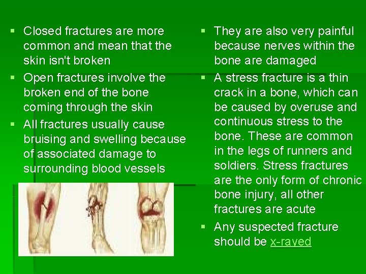 § Closed fractures are more common and mean that the skin isn't broken § § Closed fractures are more common and mean that the skin isn't broken §
