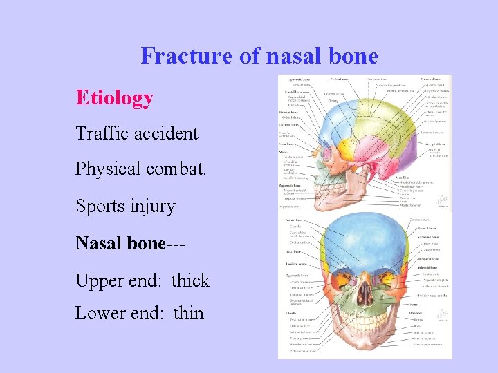 Fracture of nasal bone Etiology Traffic accident Physical combat. Sports injury Nasal bone--Upper end: