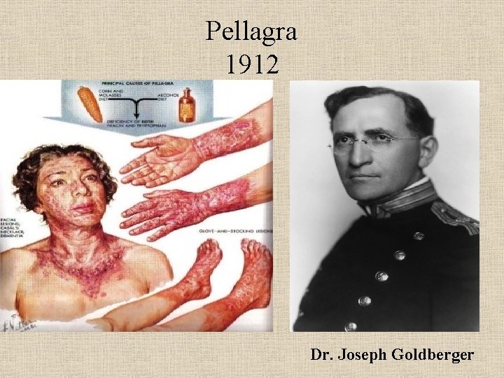 Pellagra 1912 Dr. Joseph Goldberger 
