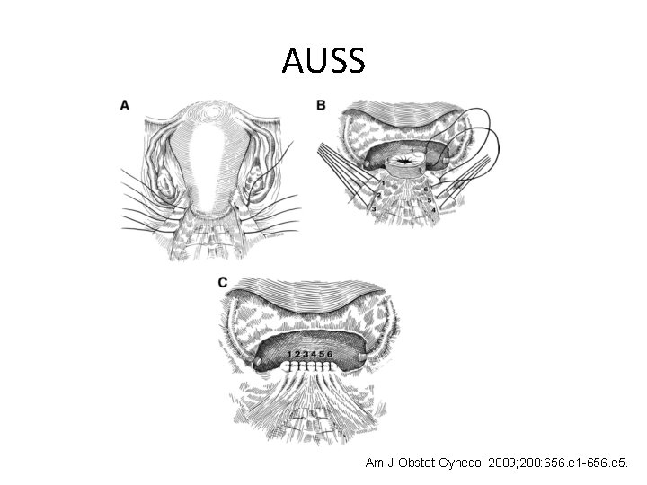 AUSS Am J Obstet Gynecol 2009; 200: 656. e 1 -656. e 5. 