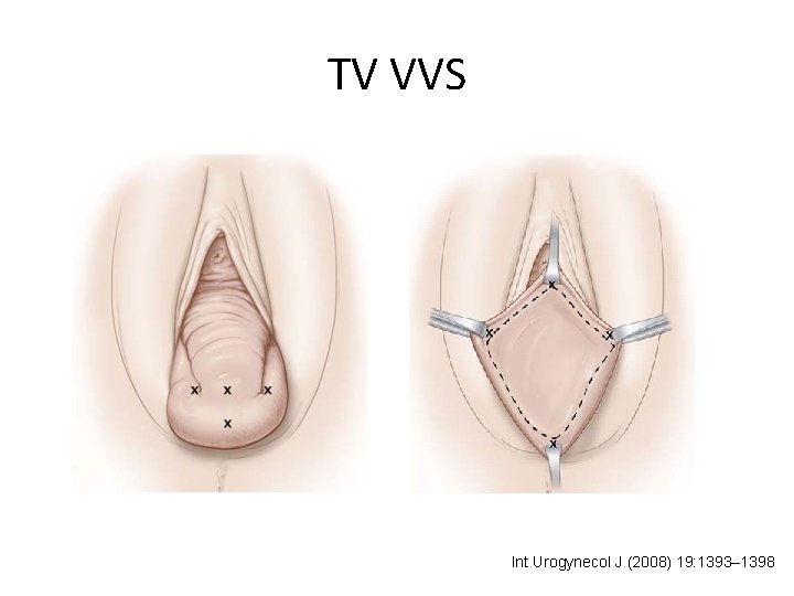 TV VVS Int Urogynecol J (2008) 19: 1393– 1398 