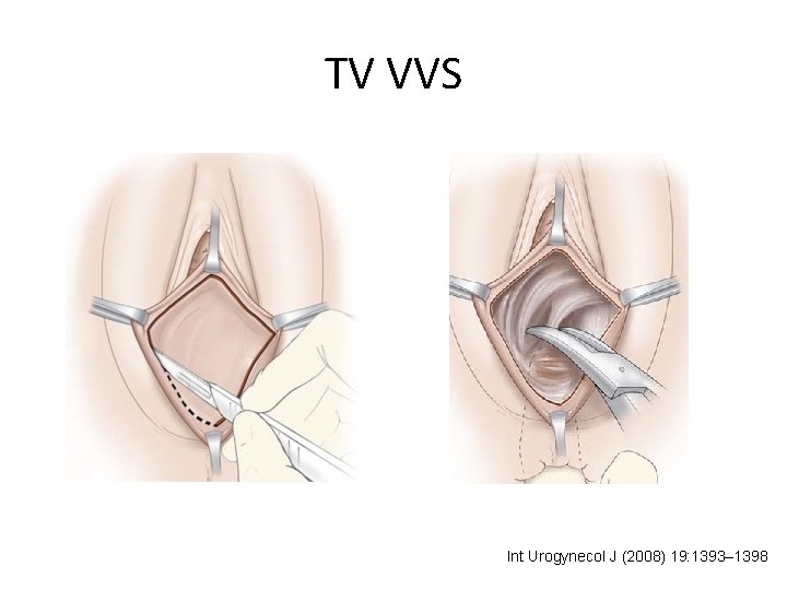 TV VVS Int Urogynecol J (2008) 19: 1393– 1398 