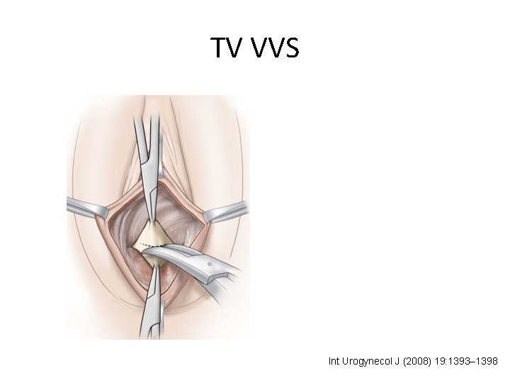 TV VVS Int Urogynecol J (2008) 19: 1393– 1398 