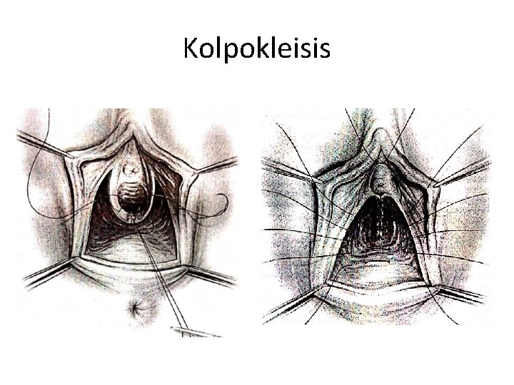 Kolpokleisis 