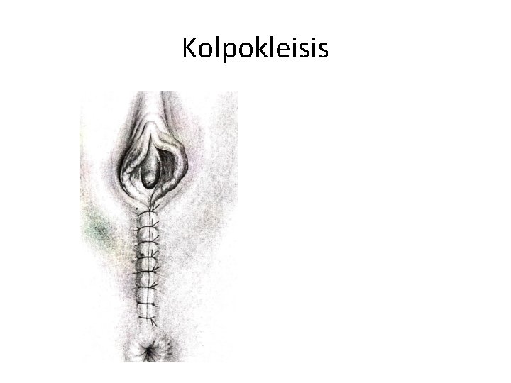 Kolpokleisis 