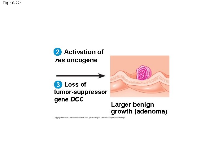 Fig. 18 -22 c 2 Activation of ras oncogene 3 Loss of tumor-suppressor gene