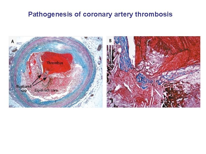 Pathogenesis of coronary artery thrombosis 